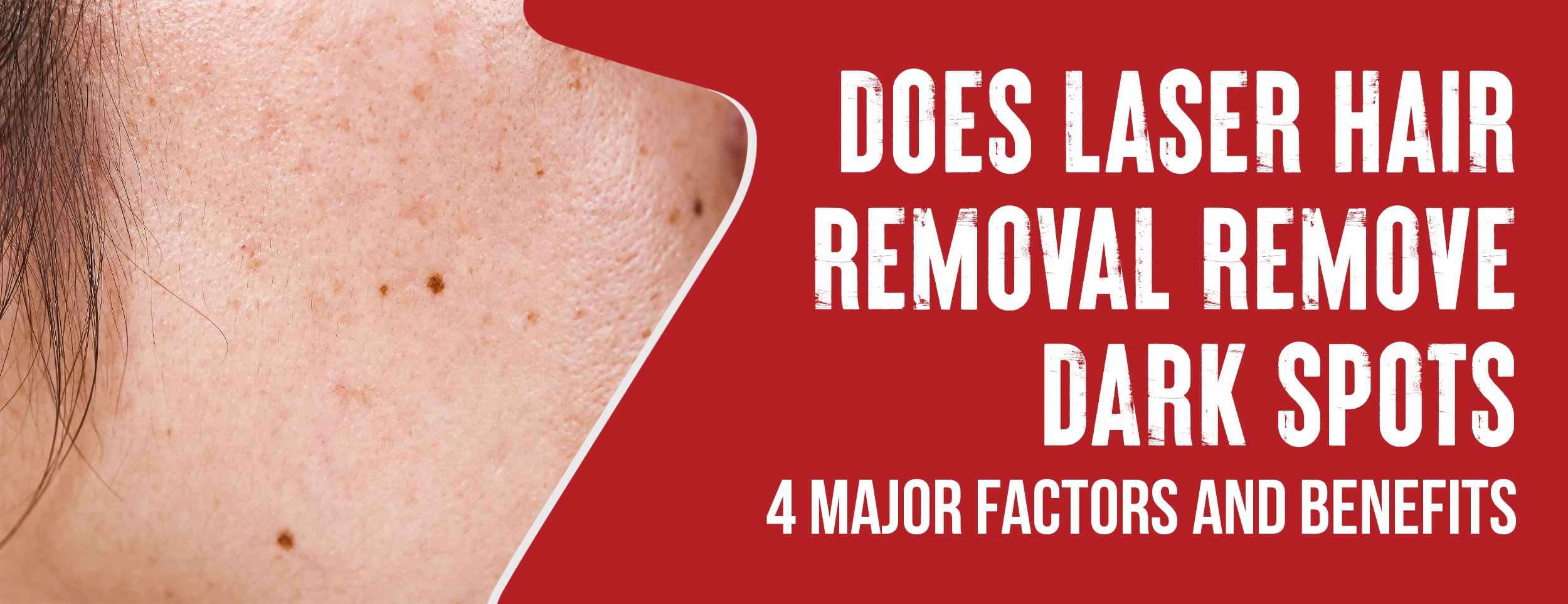 The 4 major factors and benefits of laser hair removal for dark spots