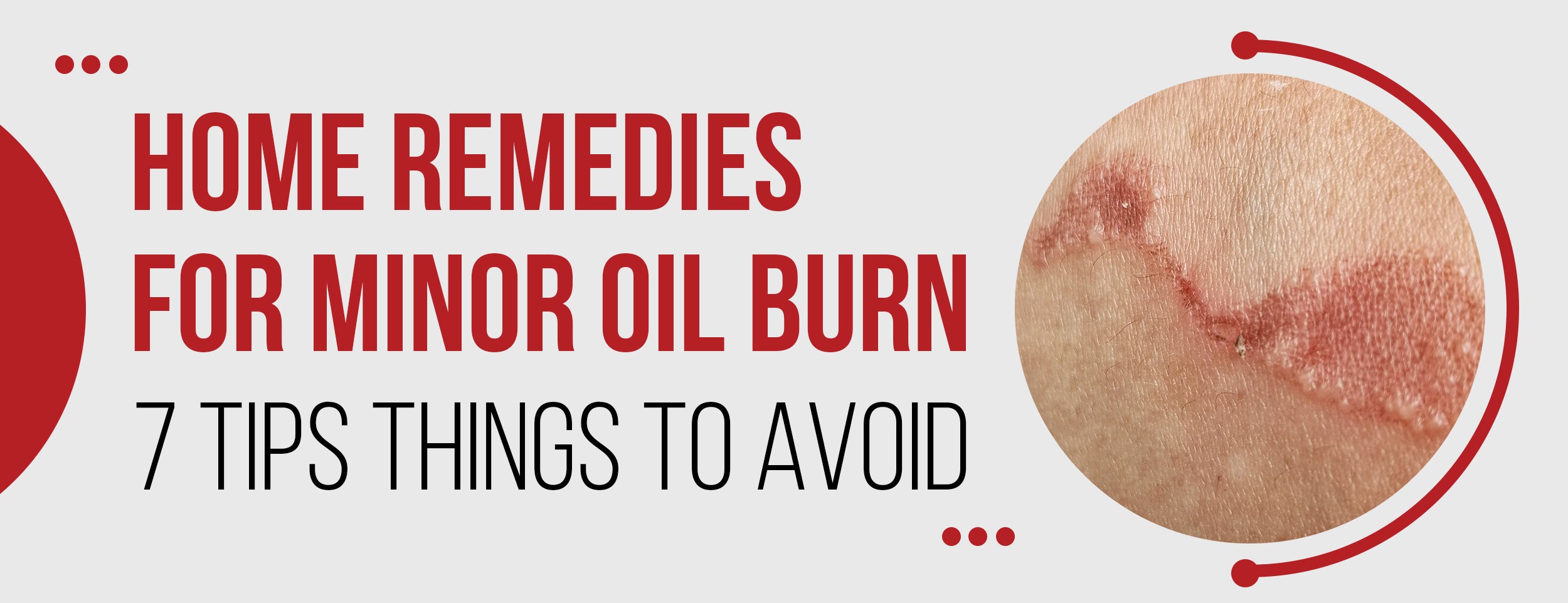 7 Best Tips & Things To Avoid When Treating Minor Oil Burns