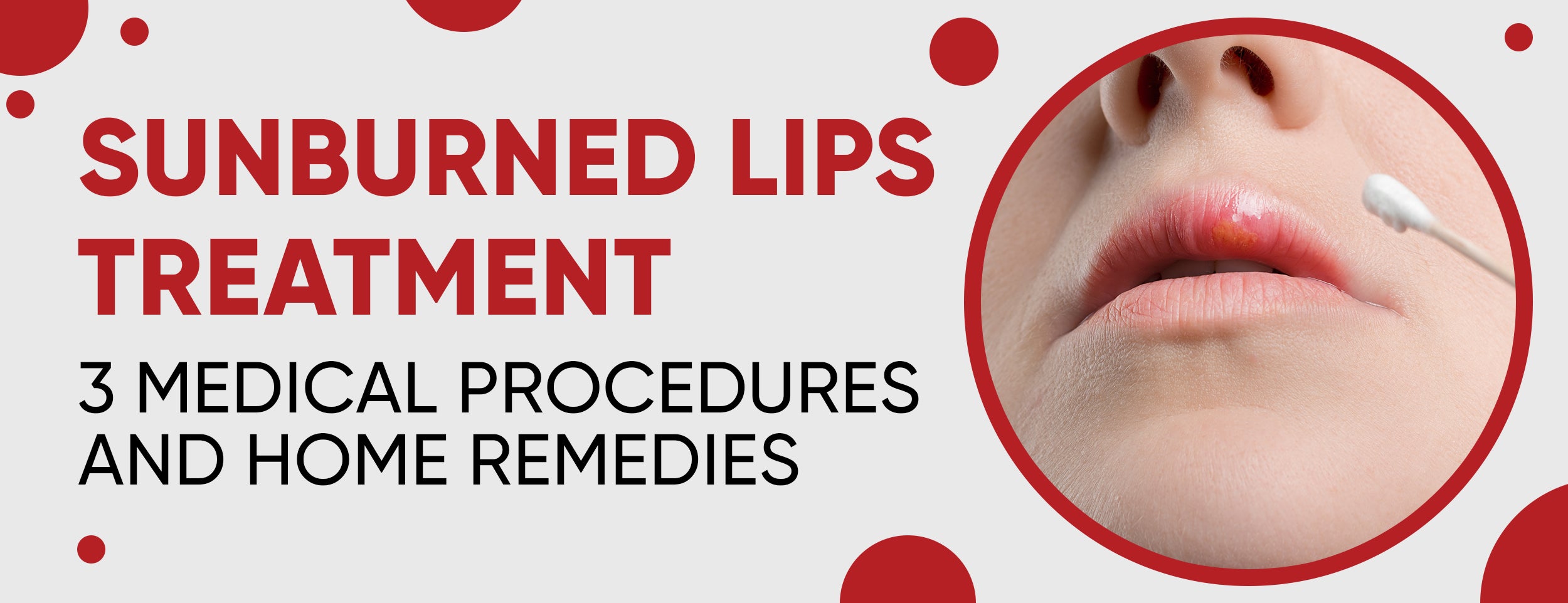 Home remedies & medical treatments for sunburned lips
